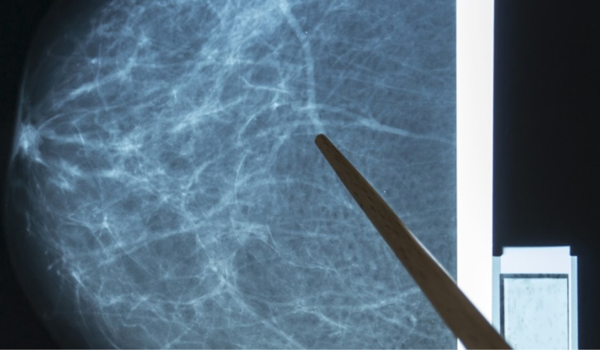 Mastografía Digital Guanajuato